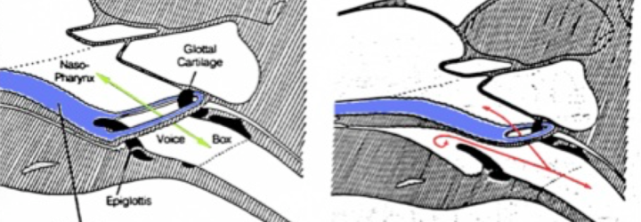 Déplacement dorsal du voile du palais