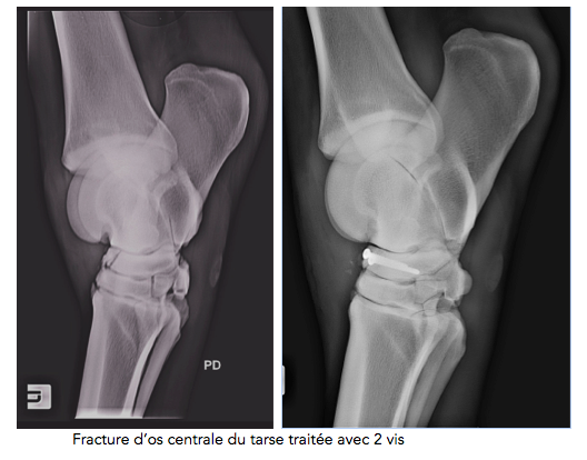 Fracture du tarse