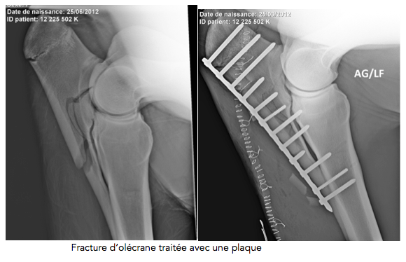 Fracture du coude