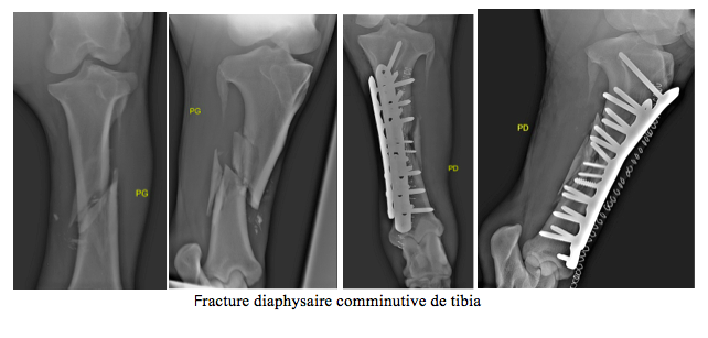 Fracture du tibia