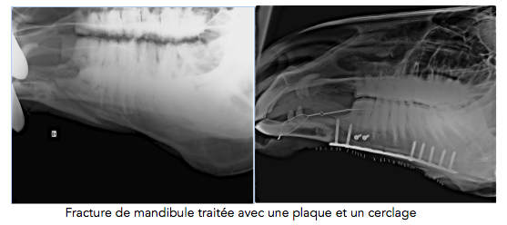 Fracture de la machoire