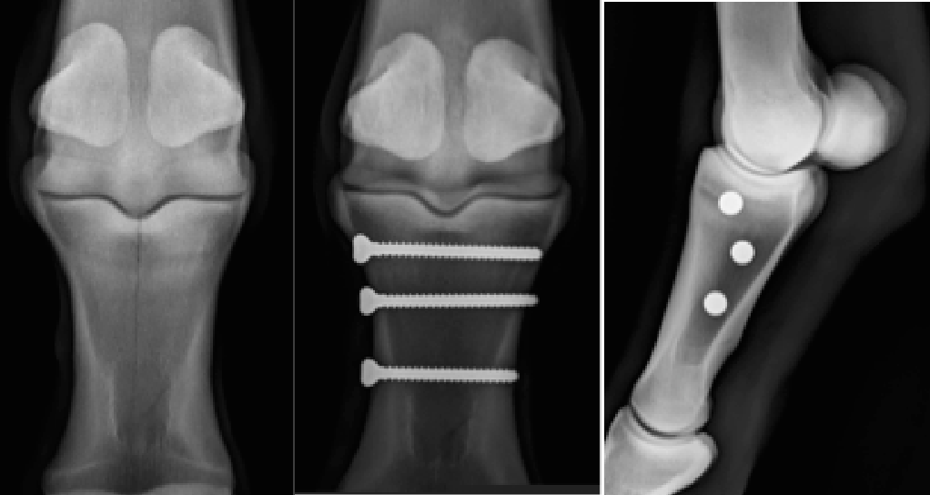 Fracture de la première phalange