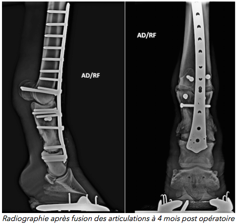 Fracture de la première phalange