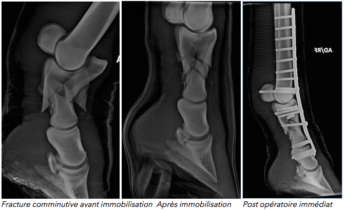 Fracture comminutive de la première phalange