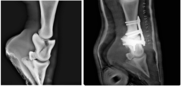 Fracture de la deuxième phalange