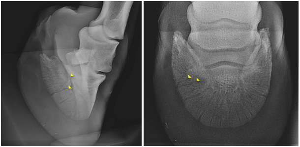 Fracture de la troisième phalange