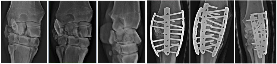 Fracture du carpe