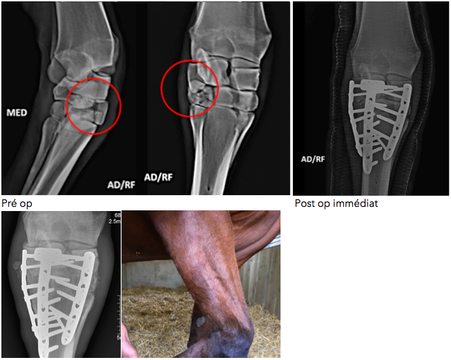 Fracture du carpe