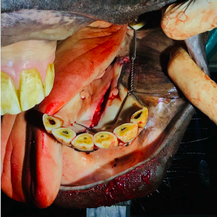Fracture de la mandibule