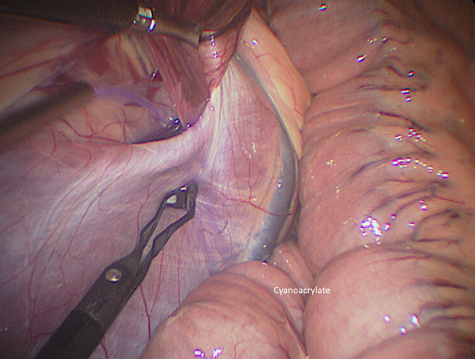 Fermeture de l'anneau inguinal